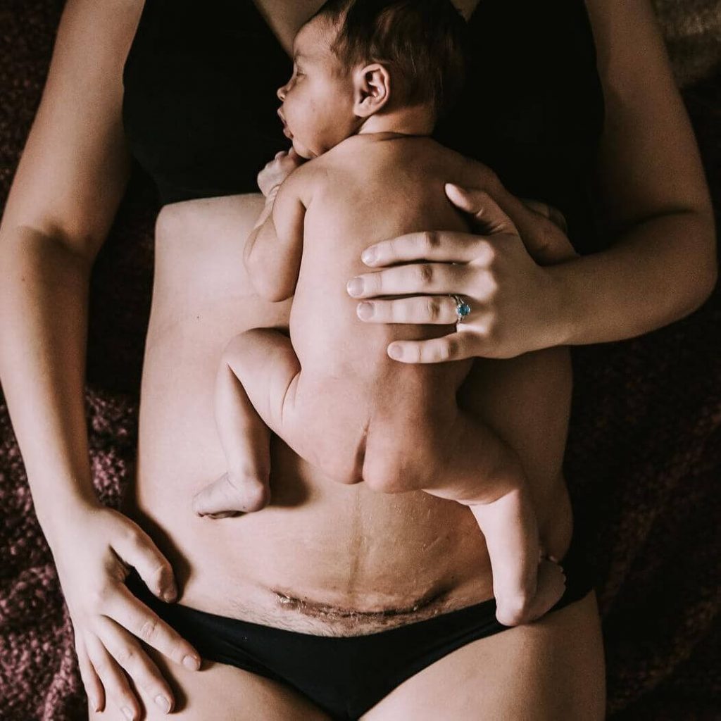 Madre e neonato dopo parto cesareo 