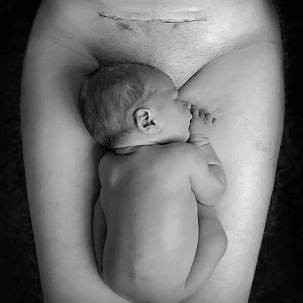 Ferita taglio cesareo ferita cesareo